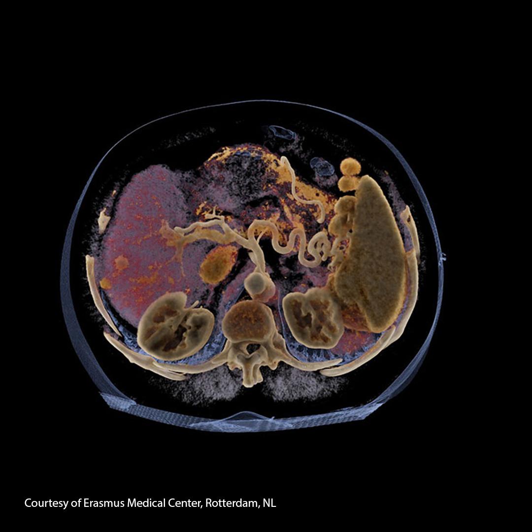 Cinematic Rendering of the liver based on monoenergetic images