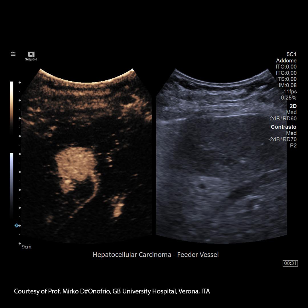 Ultrasound is one imaging modality to diagnose liver diseases and liver cancer