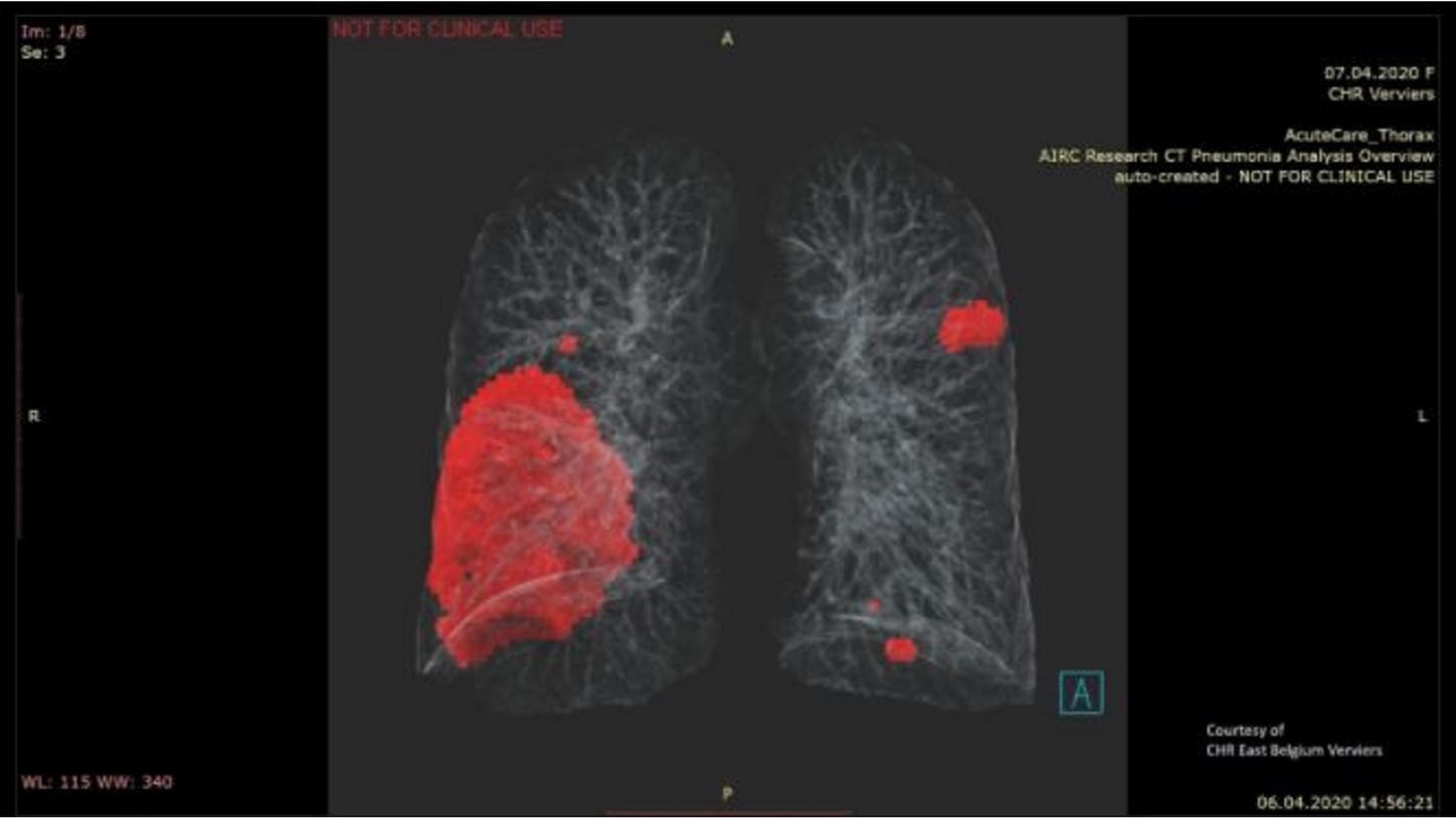 Lung CT