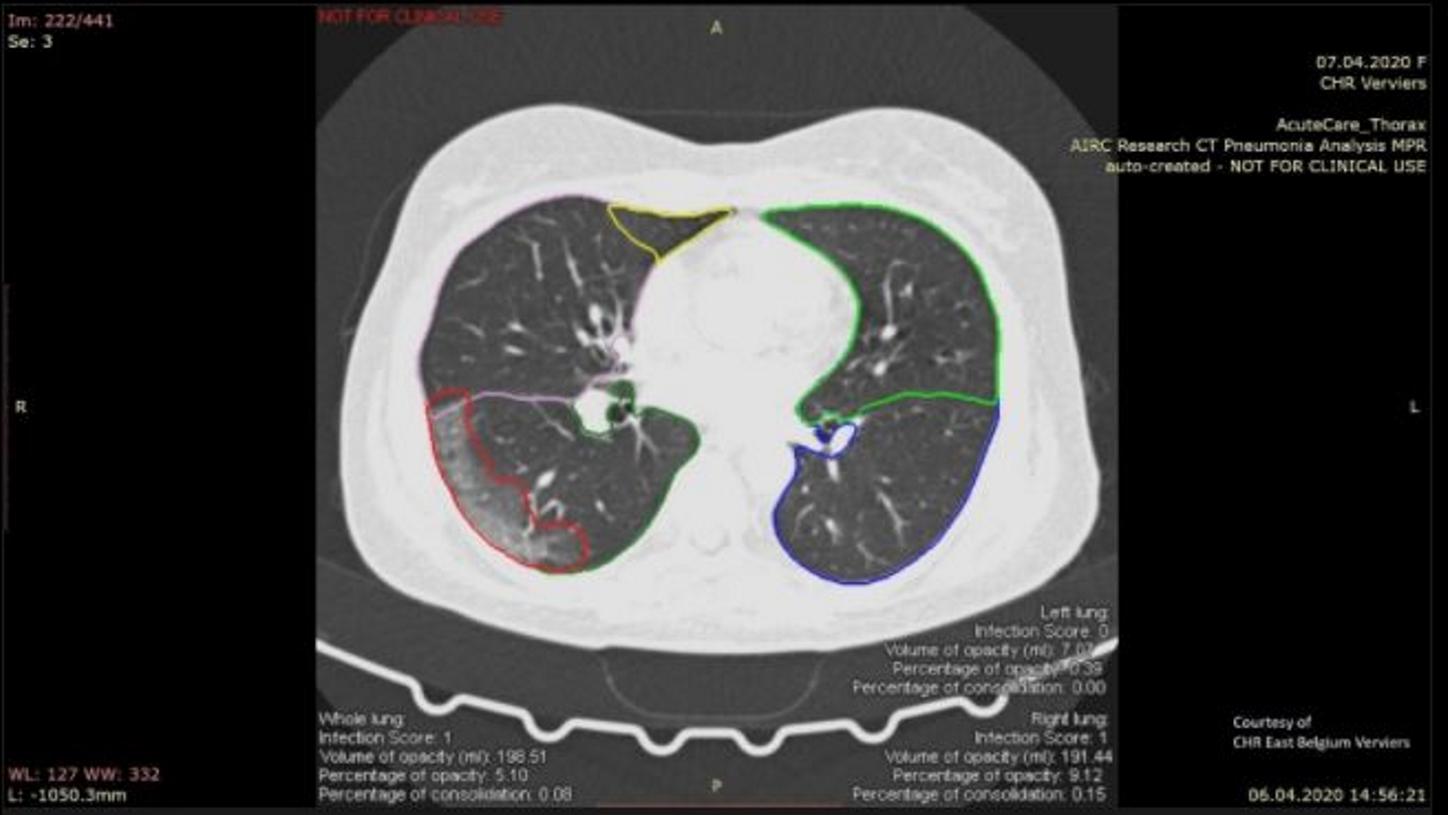 Lung CT