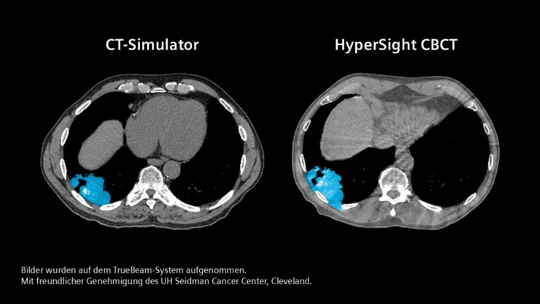 Zwei klinische Bilder, das linke zeigt einen Scan aus einer Simulation mit CT, auf dem Sie einen Tumor sehen können. Das Bild rechts zeigt einen Scan mit HyperSight CBCT (TrueBeam), bei dem der Tumor deutlich gewachsen ist.