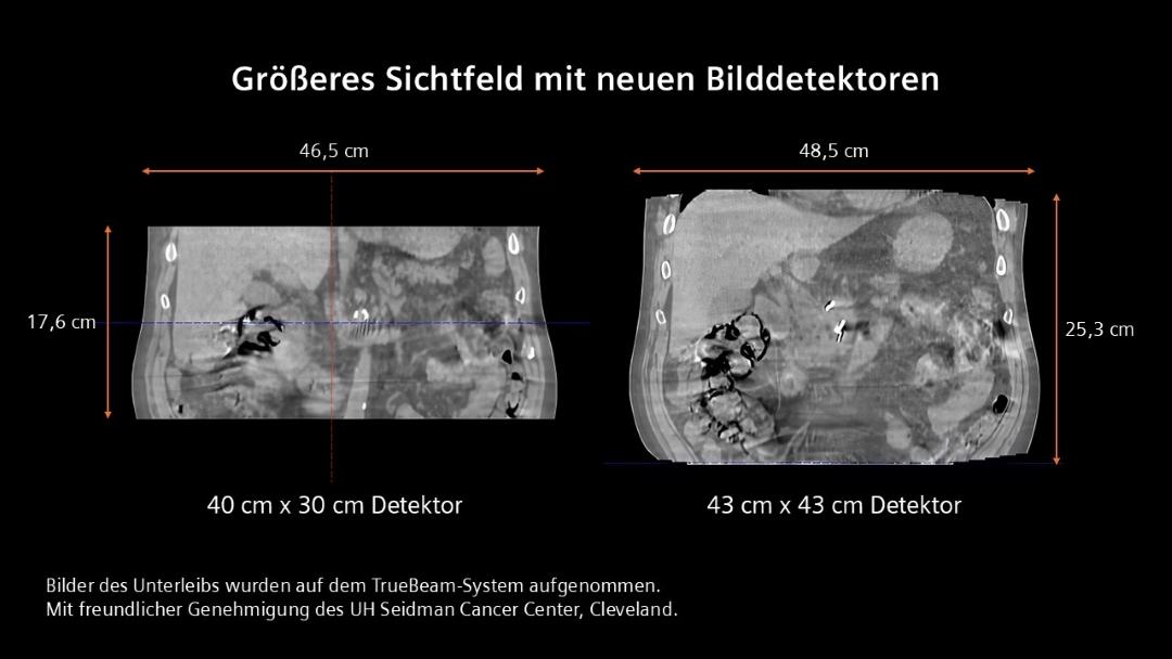 Zwei klinische Bilder, die Scans eines Abdomens mit TrueBeam zeigen, mit einem 40 cm x 30 cm großen Panel auf der linken Seite und mit einem 43 cm x 43 cm großen Panel auf der rechten Seite. Die neuen Bildpanele bieten ein größeres Sichtfeld.