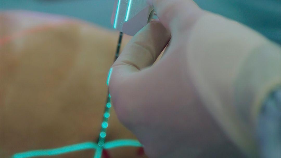 A thin, needle-like probe is inserted into the tumor through the skin.