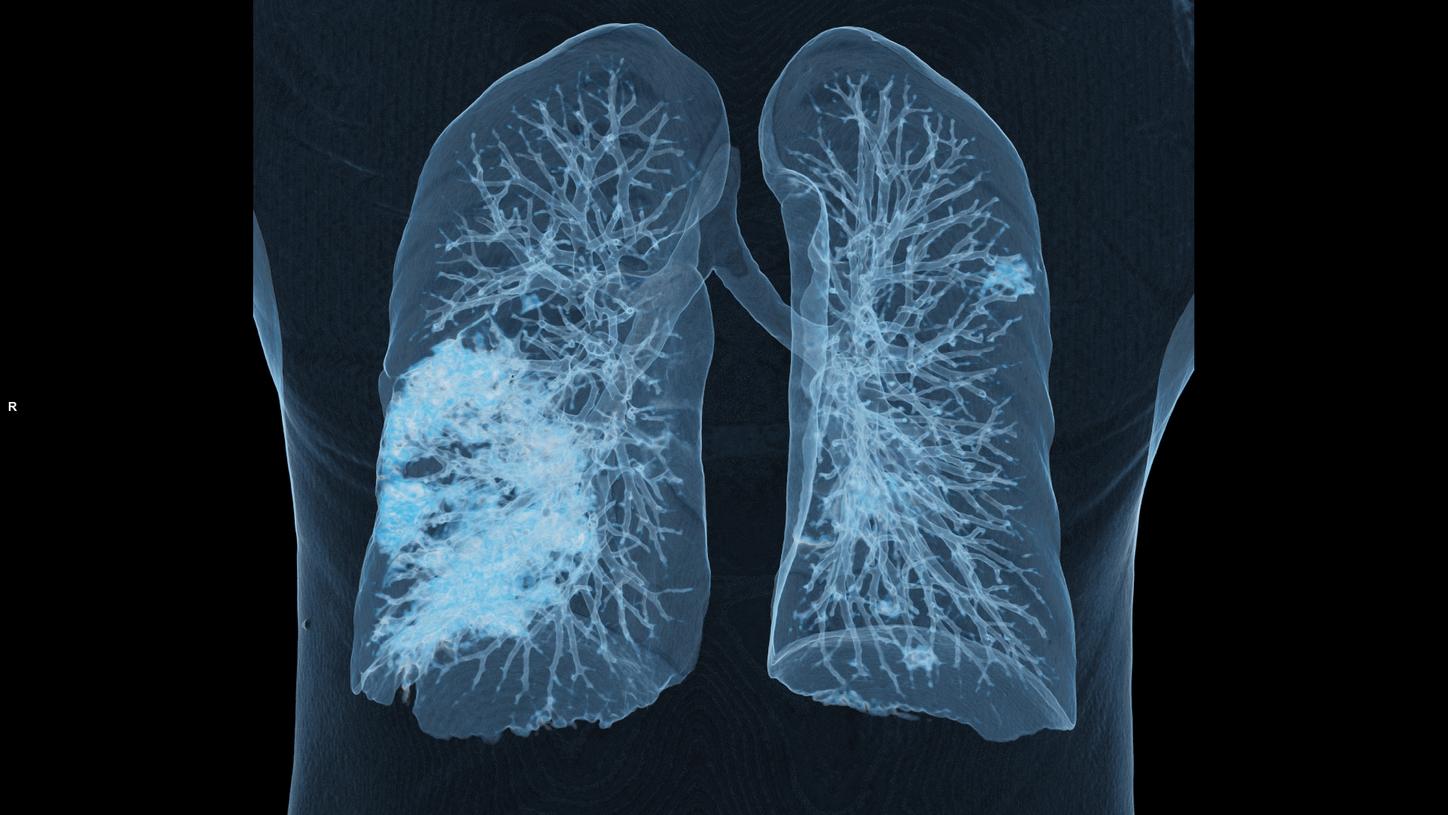 Image of the lung