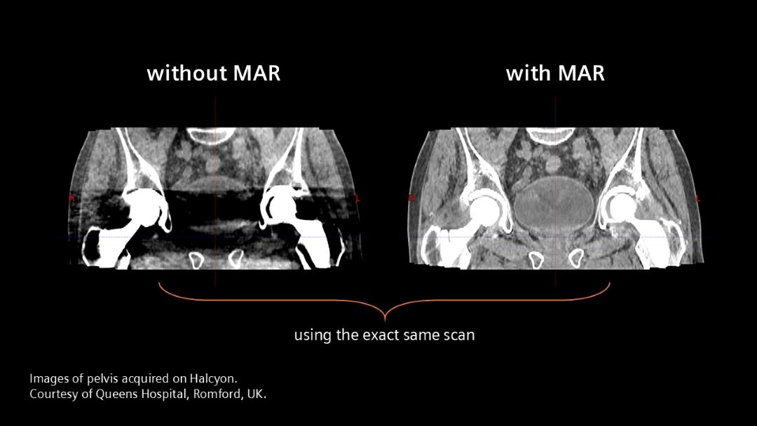 Two clinical images acquired on Halcyon showing the exact same scan of the pelvis region. The one on the left is without metal artifact reduction and some of parts of the hip appear black because the hip prosthesis results in an artifact. The image on the right uses algorithms for metal artifact reduction and shows no artifacts.