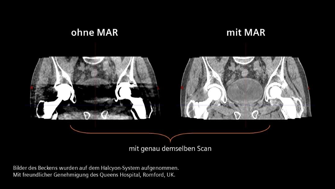 Zwei klinische Bilder, die mit Halcyon aufgenommen wurden und genau denselben Scan der Beckenregion zeigen. Die linke ist ohne Reduktion von Metallartefakten und einige Teile der Hüfte erscheinen schwarz, weil die Hüftprothese zu einem Artefakt führt. Das Bild auf der rechten Seite verwendet Algorithmen zur Reduzierung von Metallartefakten und zeigt keine Artefakte.
