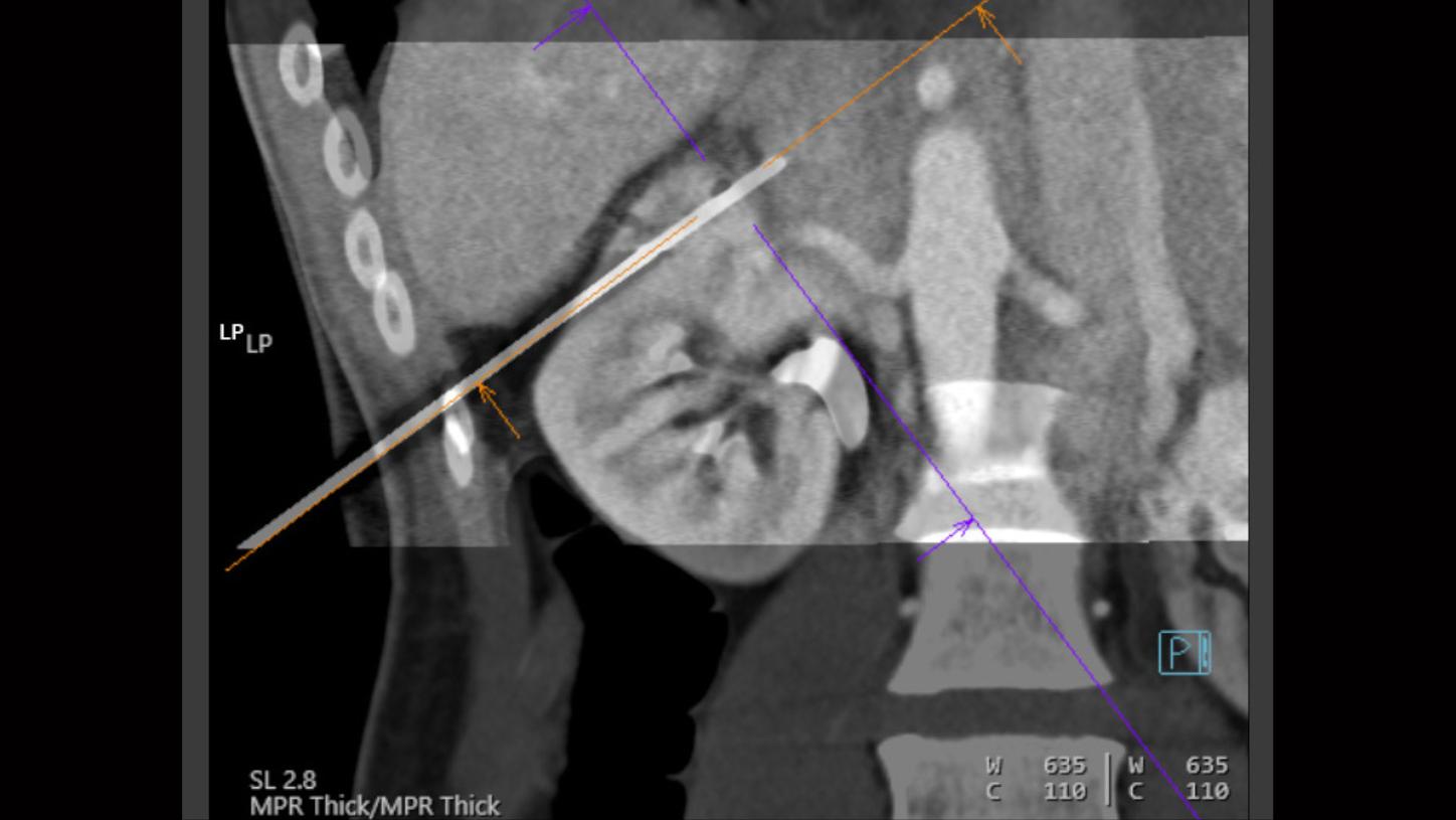 CT-guided interventions