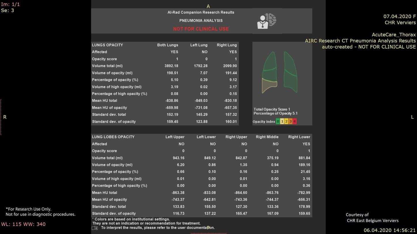Pneumonia-analysis-research-results