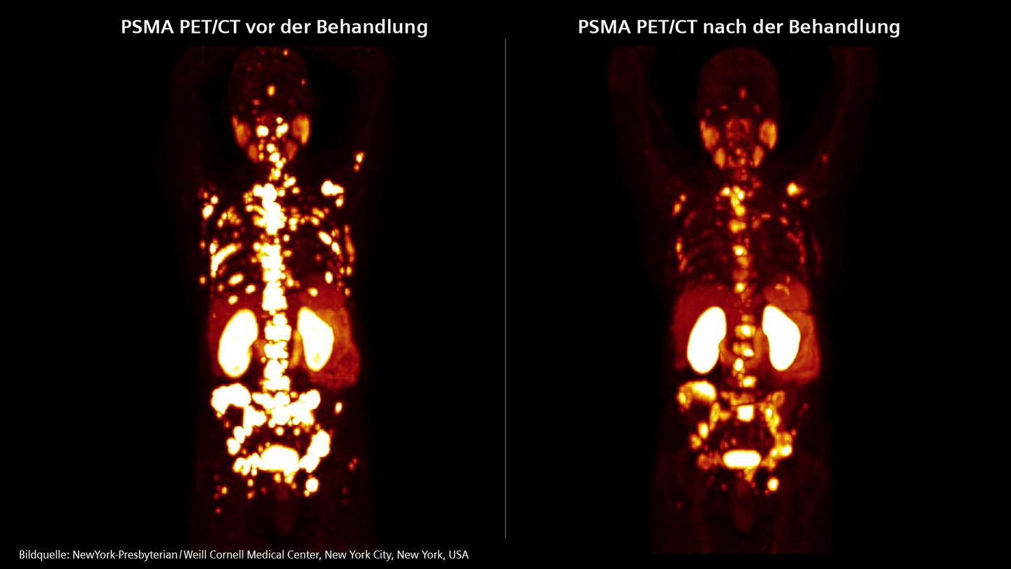 Zwei Aufnahmen: eine vor und eine nach der Behandlung PSMA PET/CT