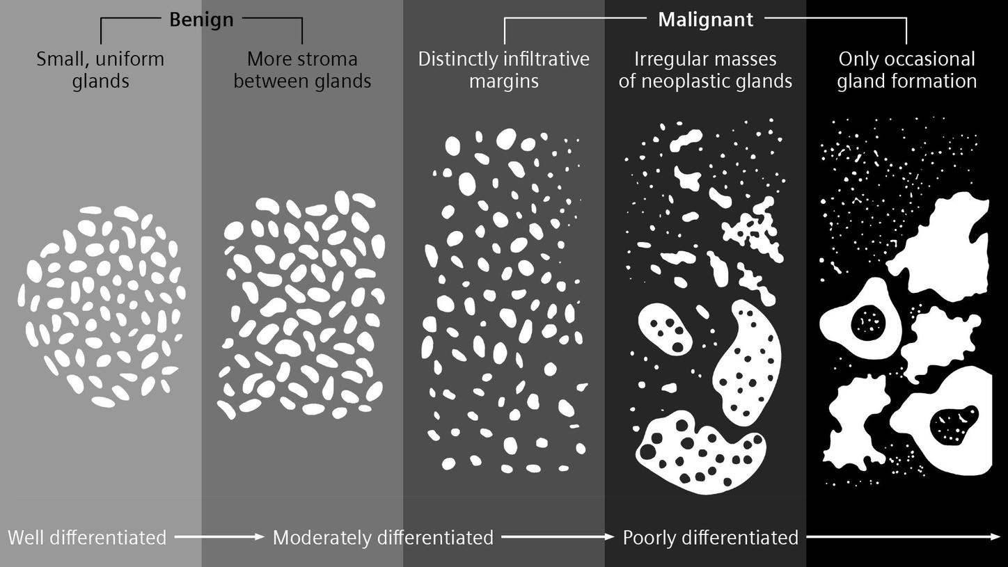 Visualization of Gleason’s pattern
