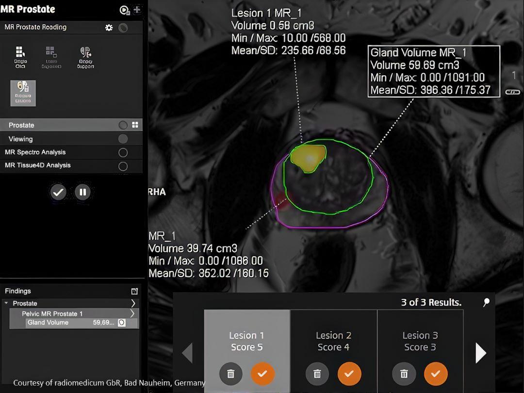 Image of prostate MRI scan supported by AI