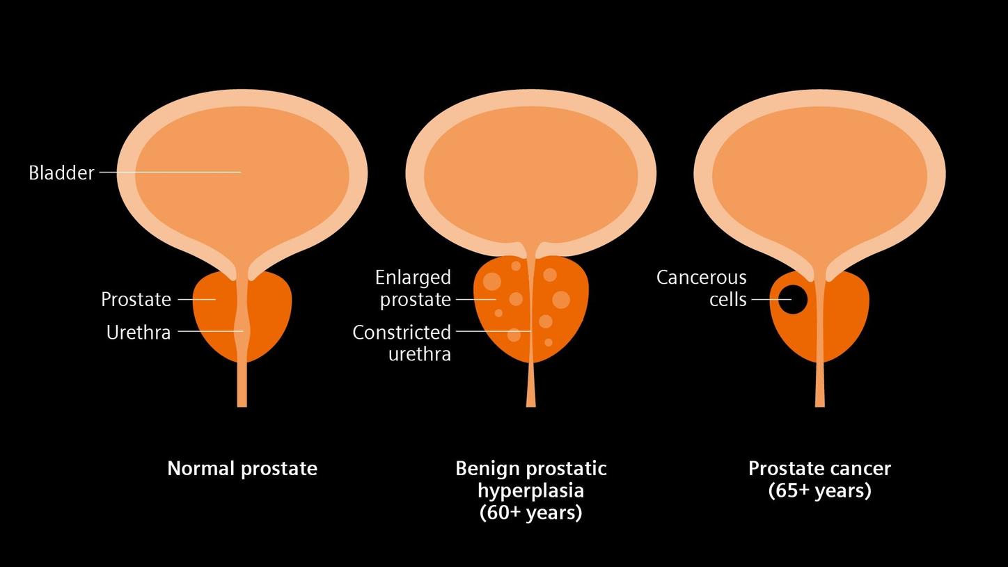 The image illustrates the differences between a normal prostate, benign prostatic hyperplasia (BPH), and prostate cancer. It shows how the prostate, bladder, and urethra are affected in each condition.