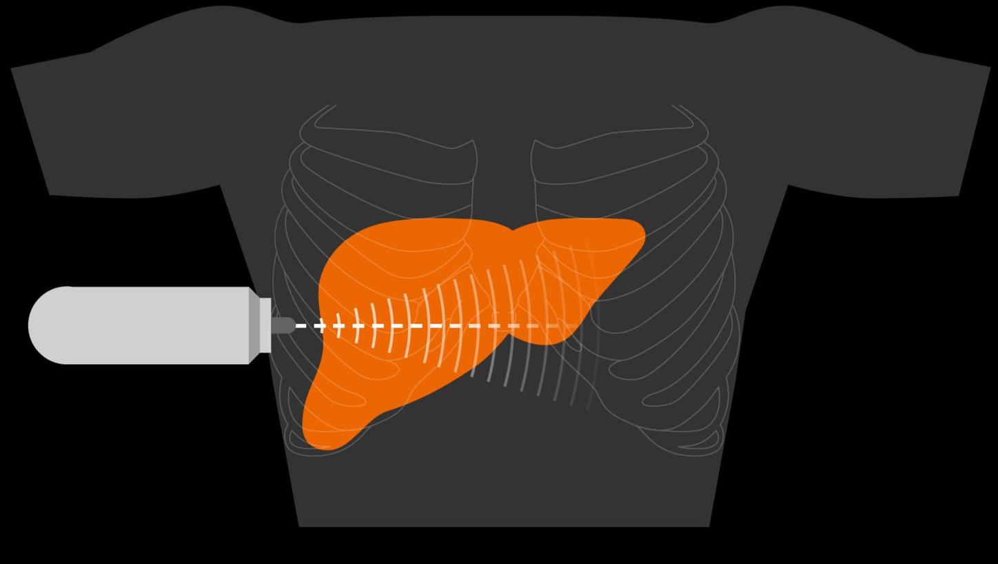An illustration shows how a probe emits a mechanical pulse towards the liver.