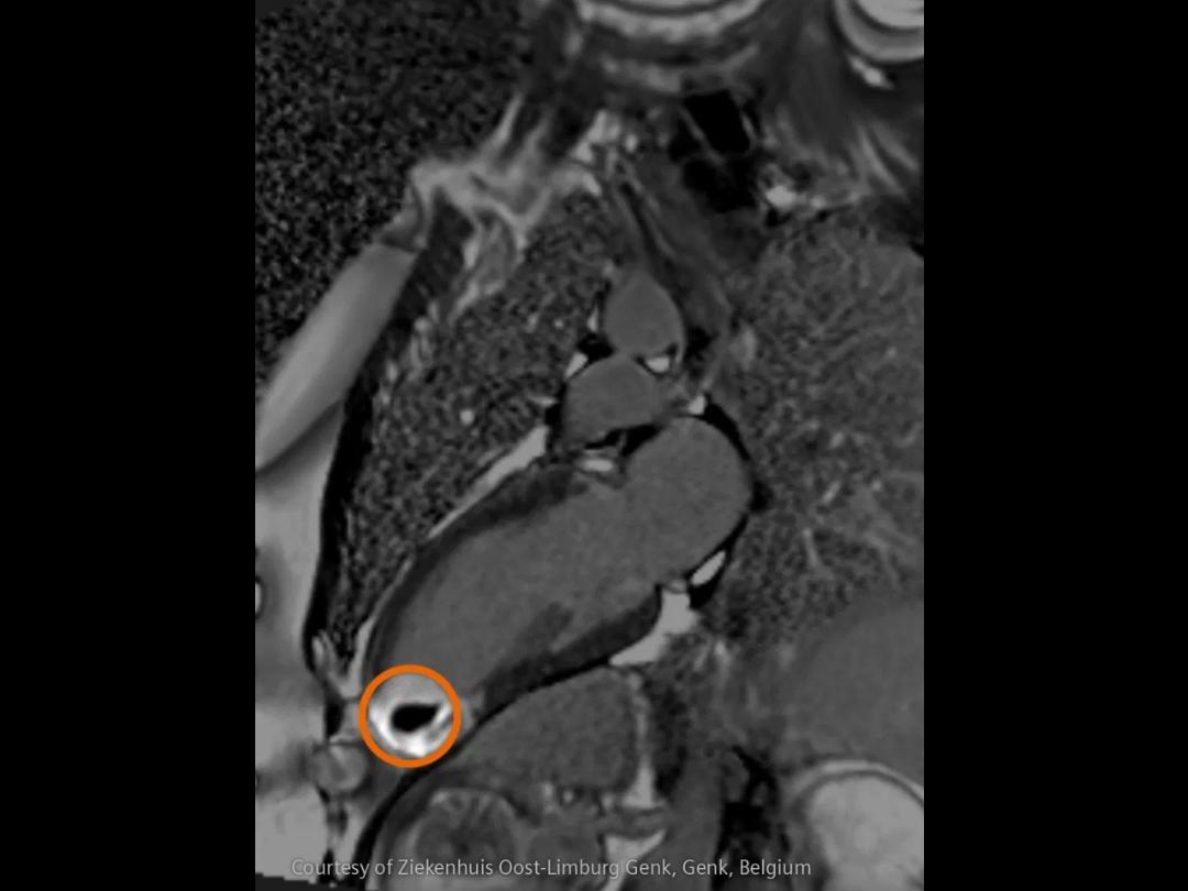 Cardioembolic stroke