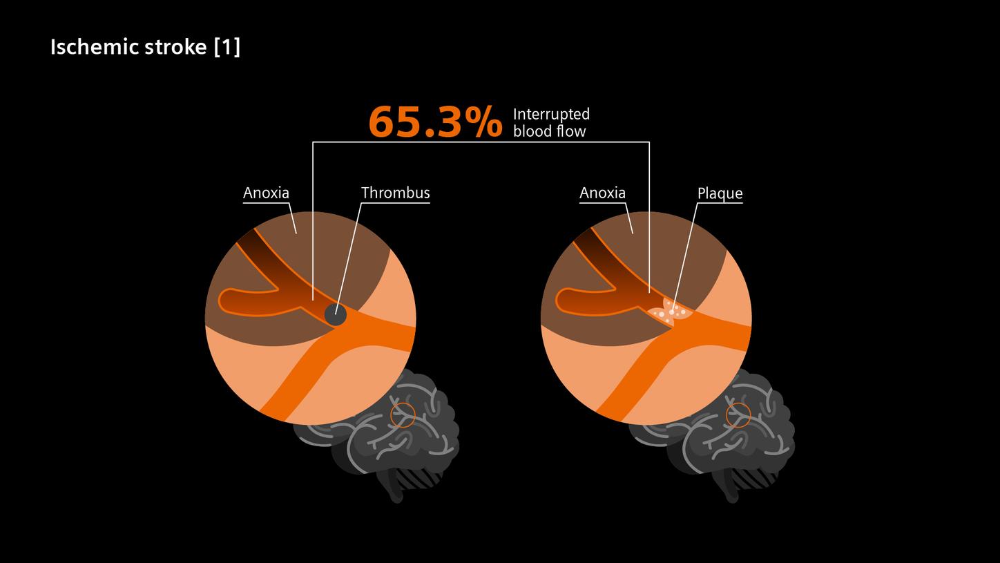 When it comes to stroke, most people think of ischemic stroke – but identifying the exact type is crucial for fast and effective treatment.