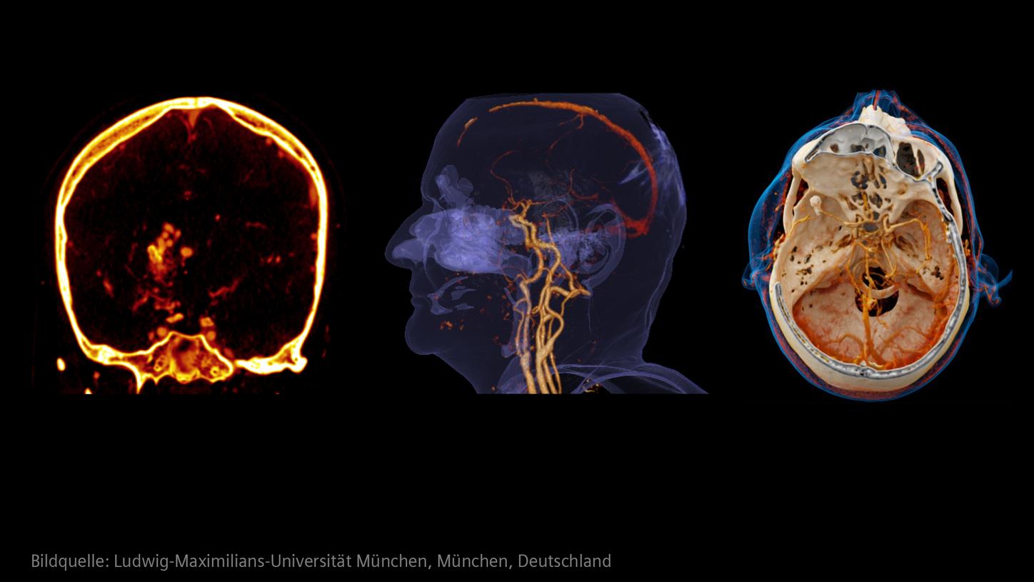 Klinische Bilder eines Schlaganfalls