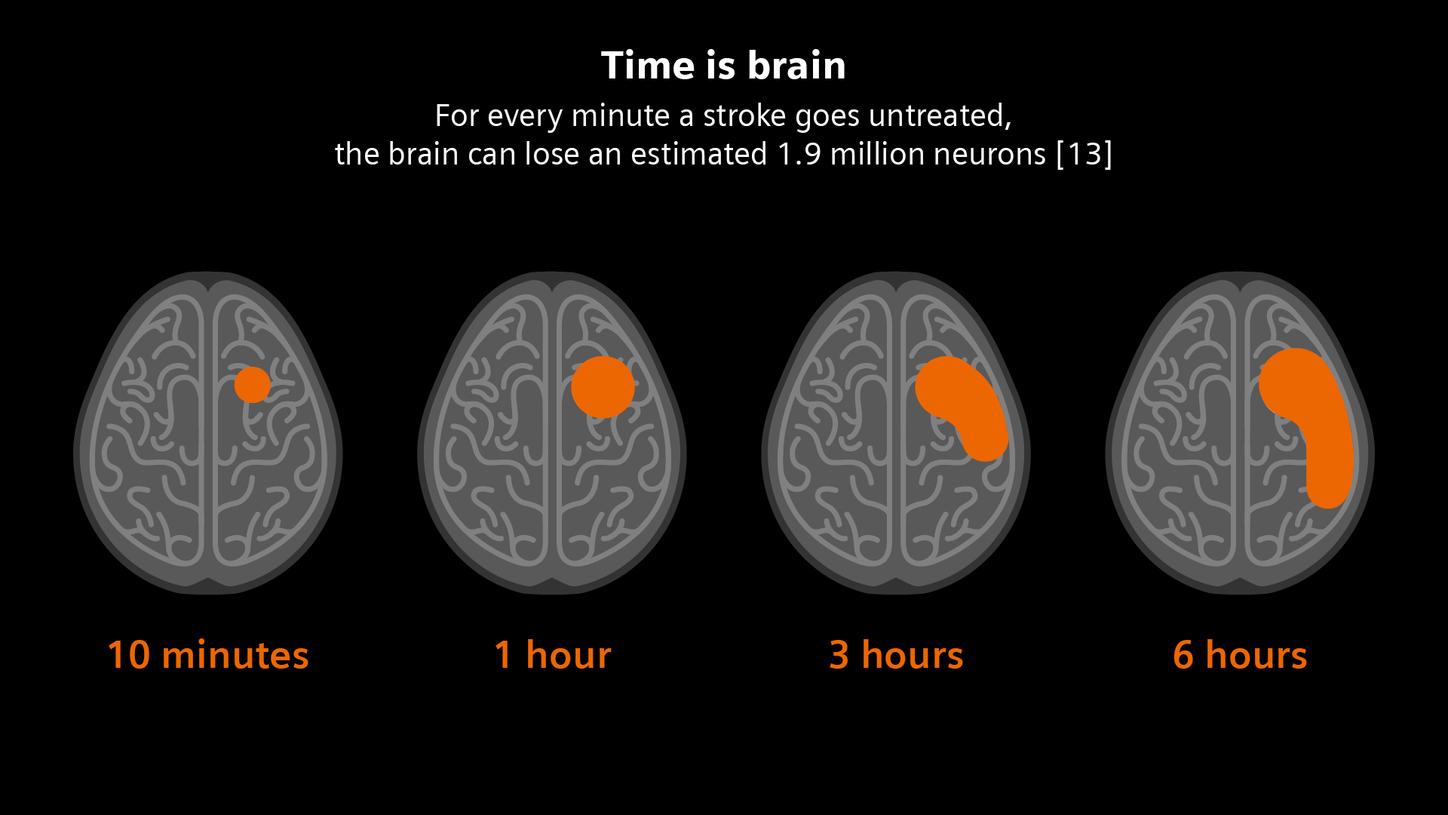 Time is brain
