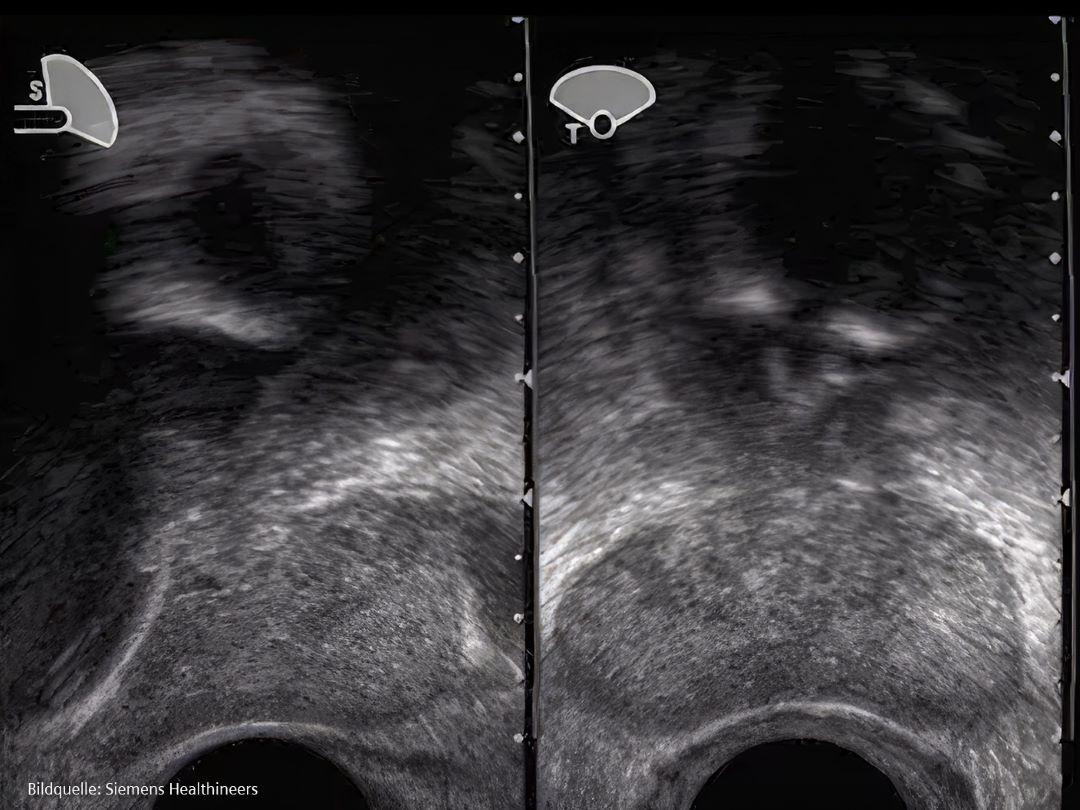 Bild eines transrektalen Ultraschalls