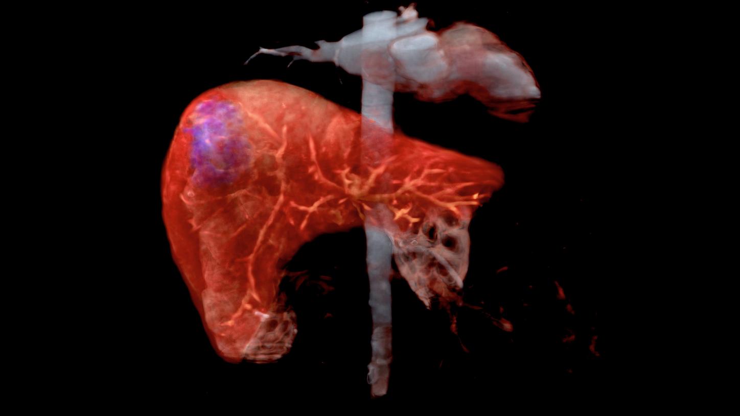 Liver cancer: Imaging of the liver used for cancer diagnosis