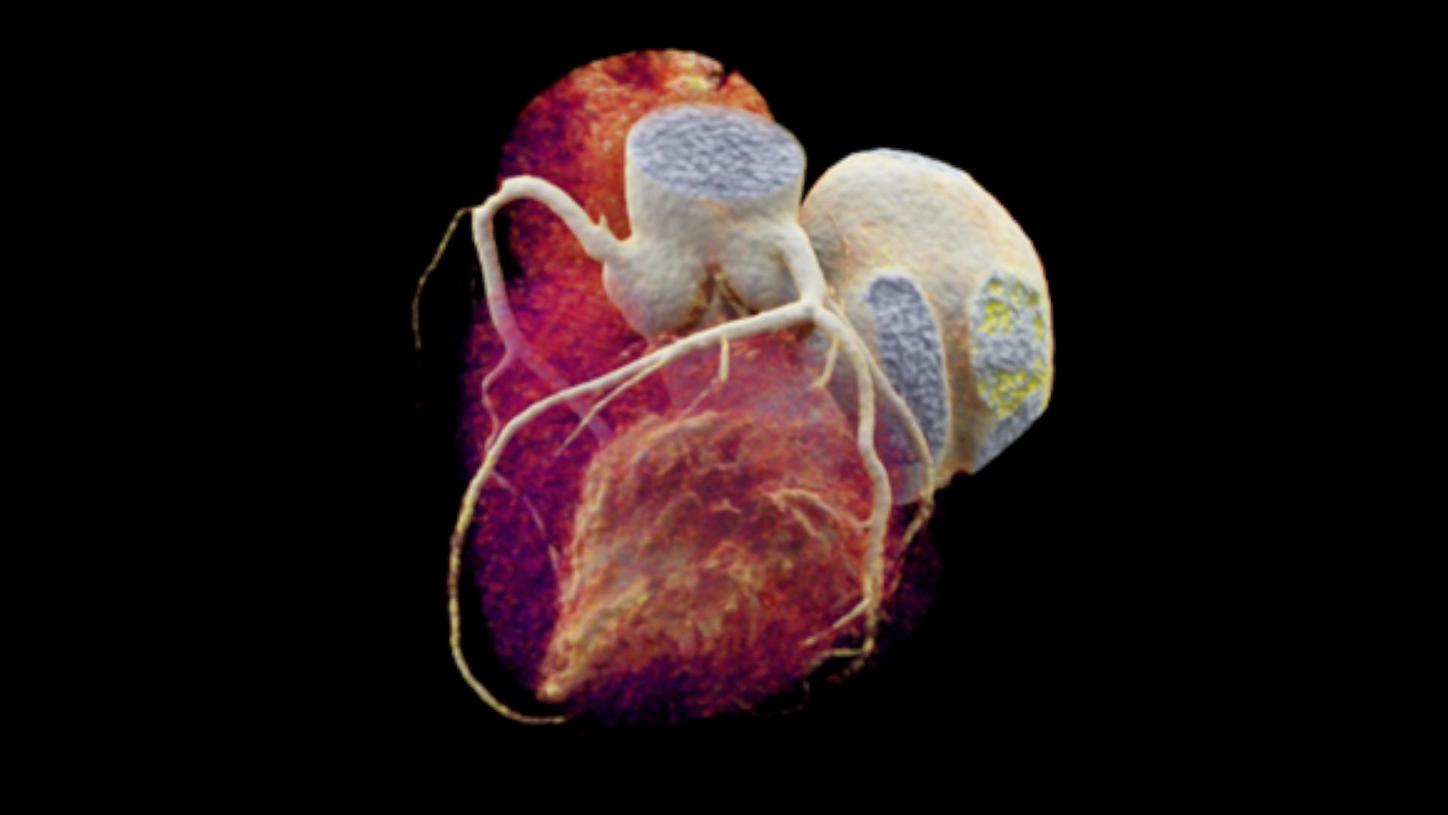 Coronary artery disease:  Imaging of the heart used for coronary artery diagnosis