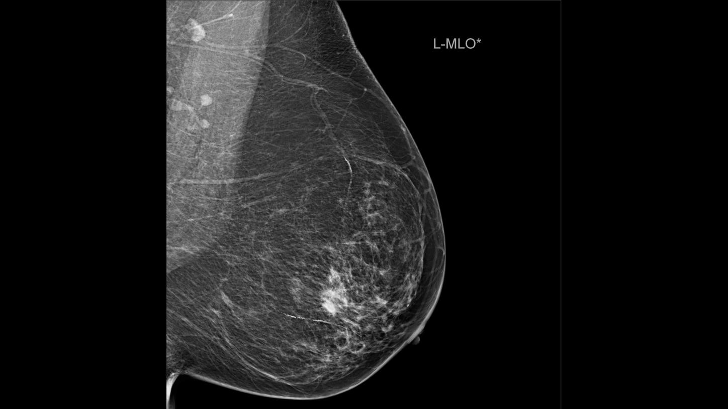 Screening & Early Detection