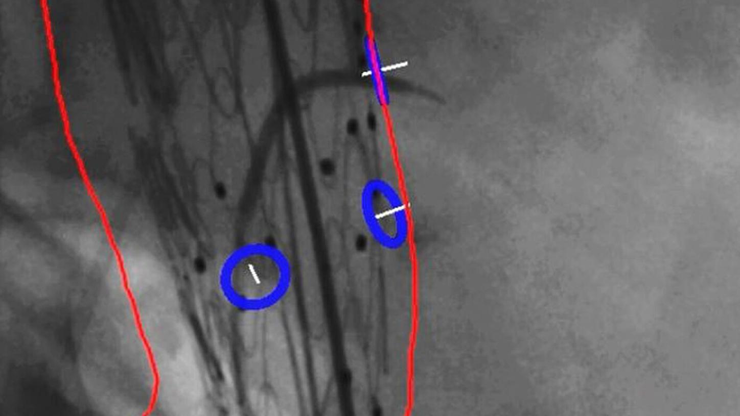 Clinical image Artis pheno Stent deployment with fusion imaging