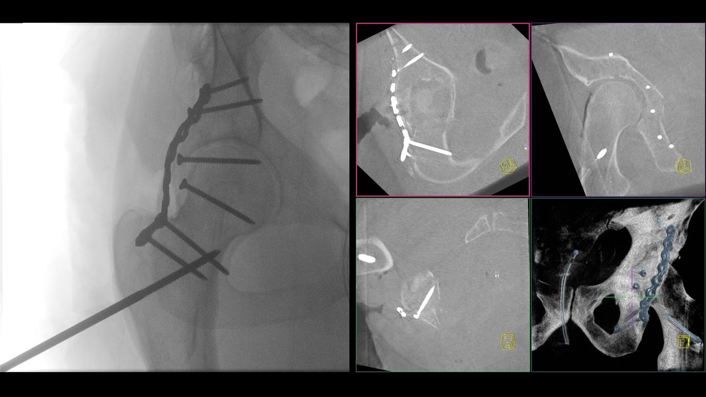 Open reduction and internal fixation using the Kocher-Langenbeck approach with a low-profile plate and two additional cannulated screws