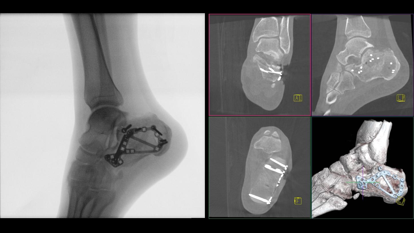 Open reduction and internal fixation using a modified sinus tarsi approach; fixation using a VA locking calcaneal plate, defect filling with allogenic cancellous bone