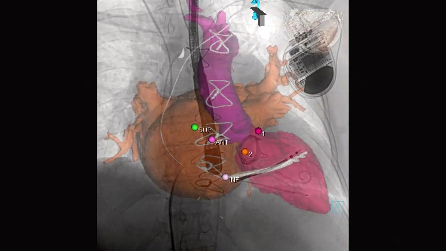 Clinical image that shows an overlay of TEE and CTA data onto live fluoroscopy with syngo 3D Roadmap and syngo TrueFusion