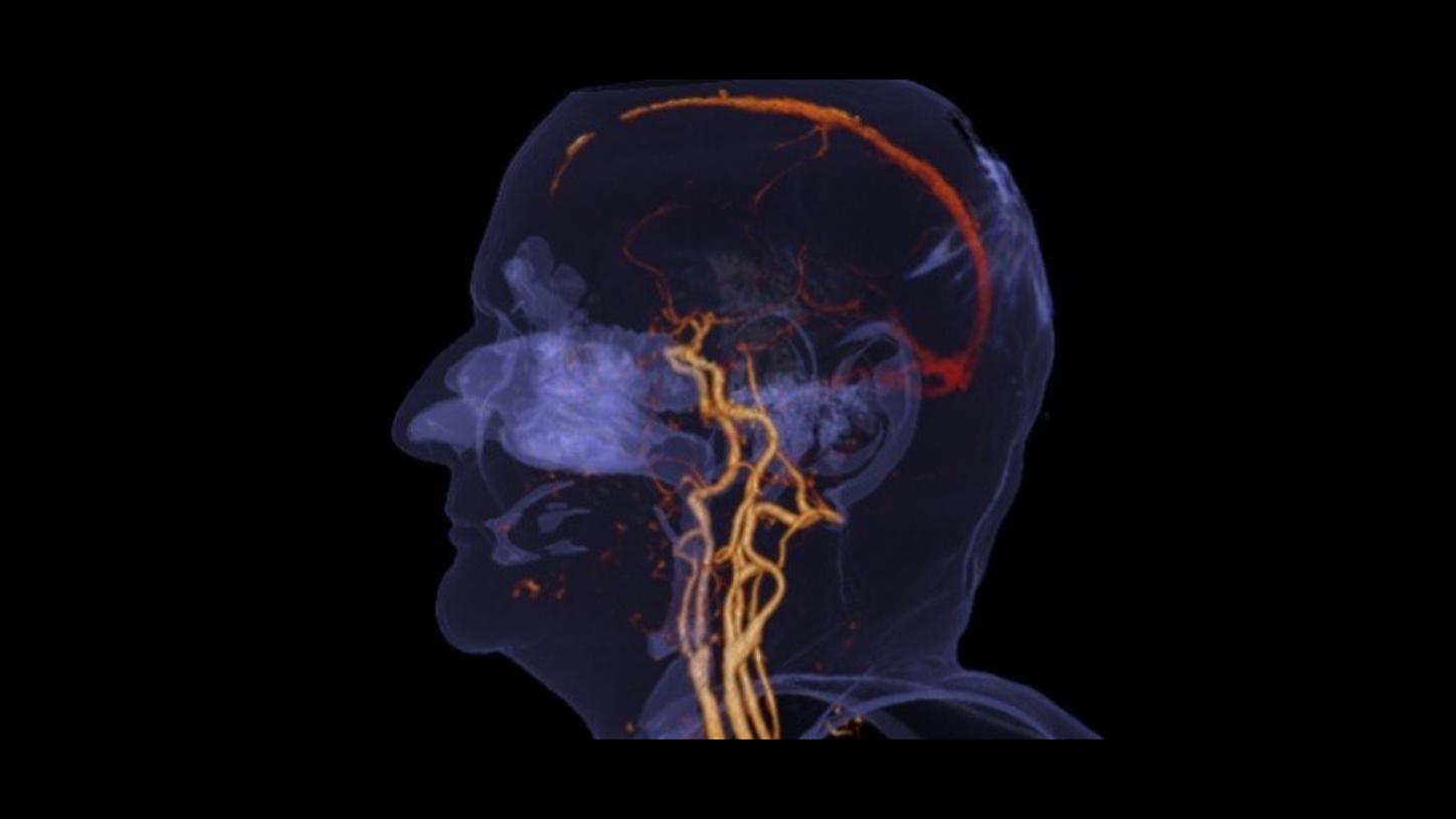 Stroke care – bone removal