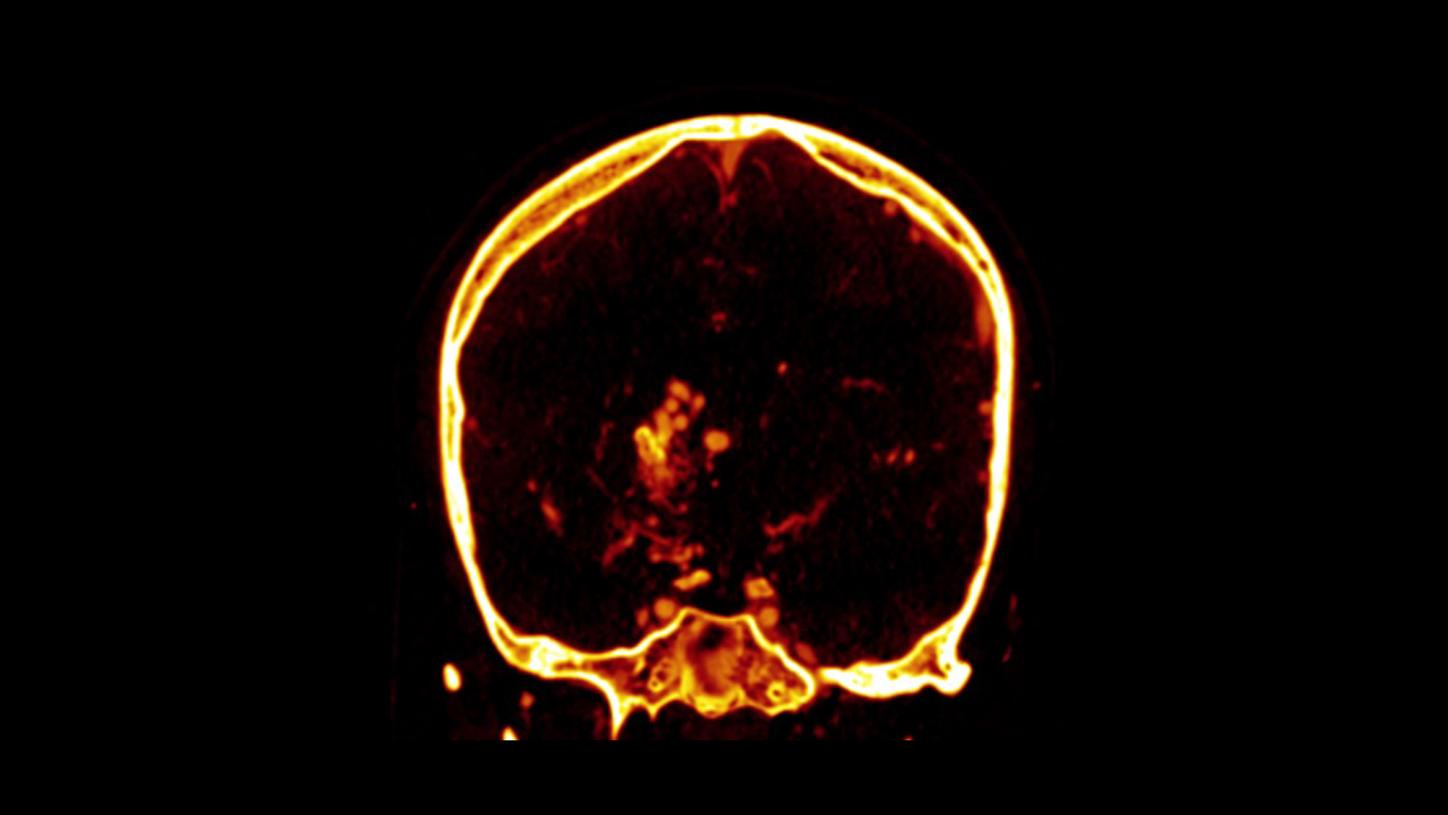 Stroke care – brain hemorrhage