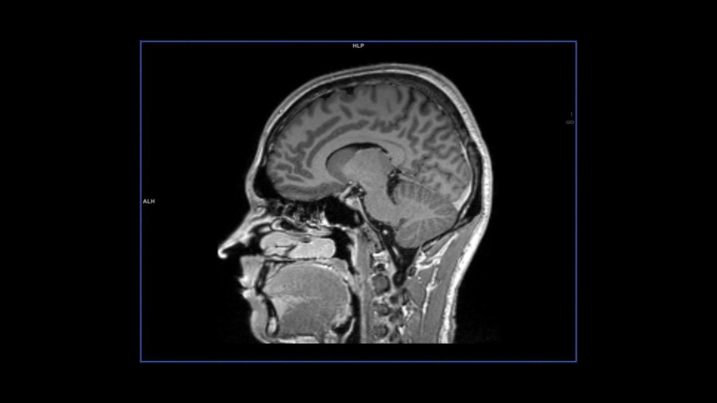 Stroke care – sagittal MPRAGE