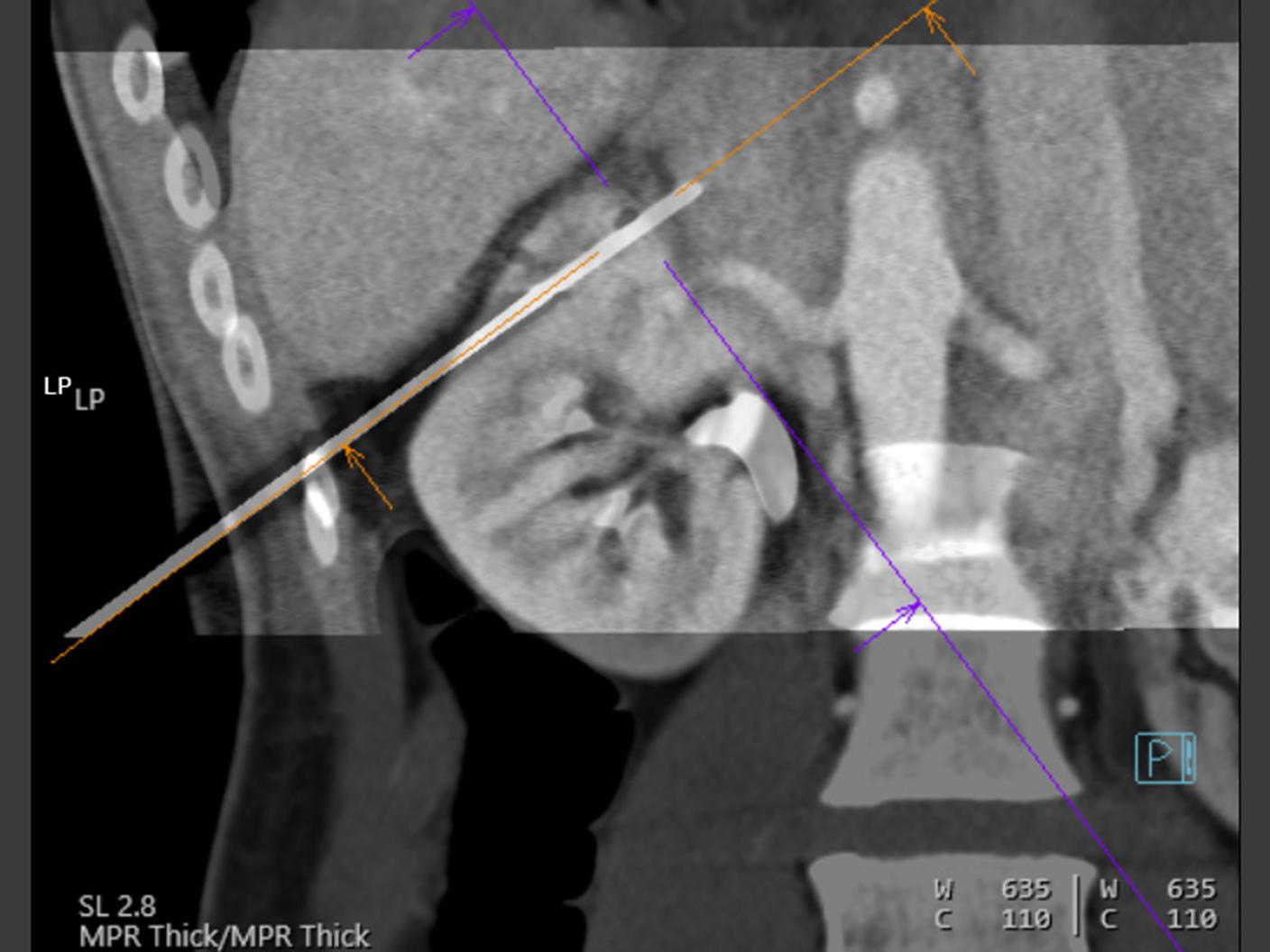 ct-guided Intervention