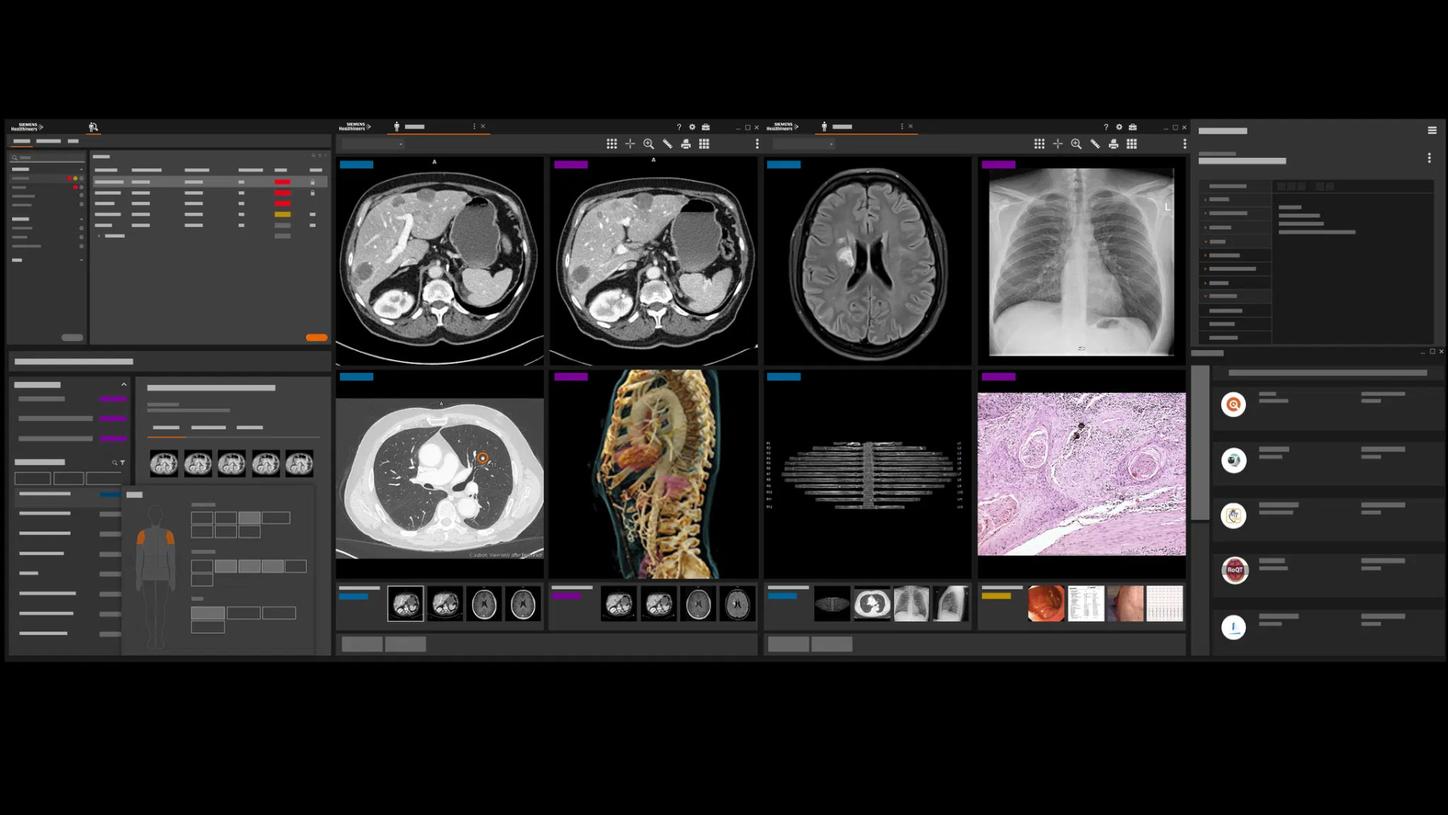 AI in radiology Syngo Carbon