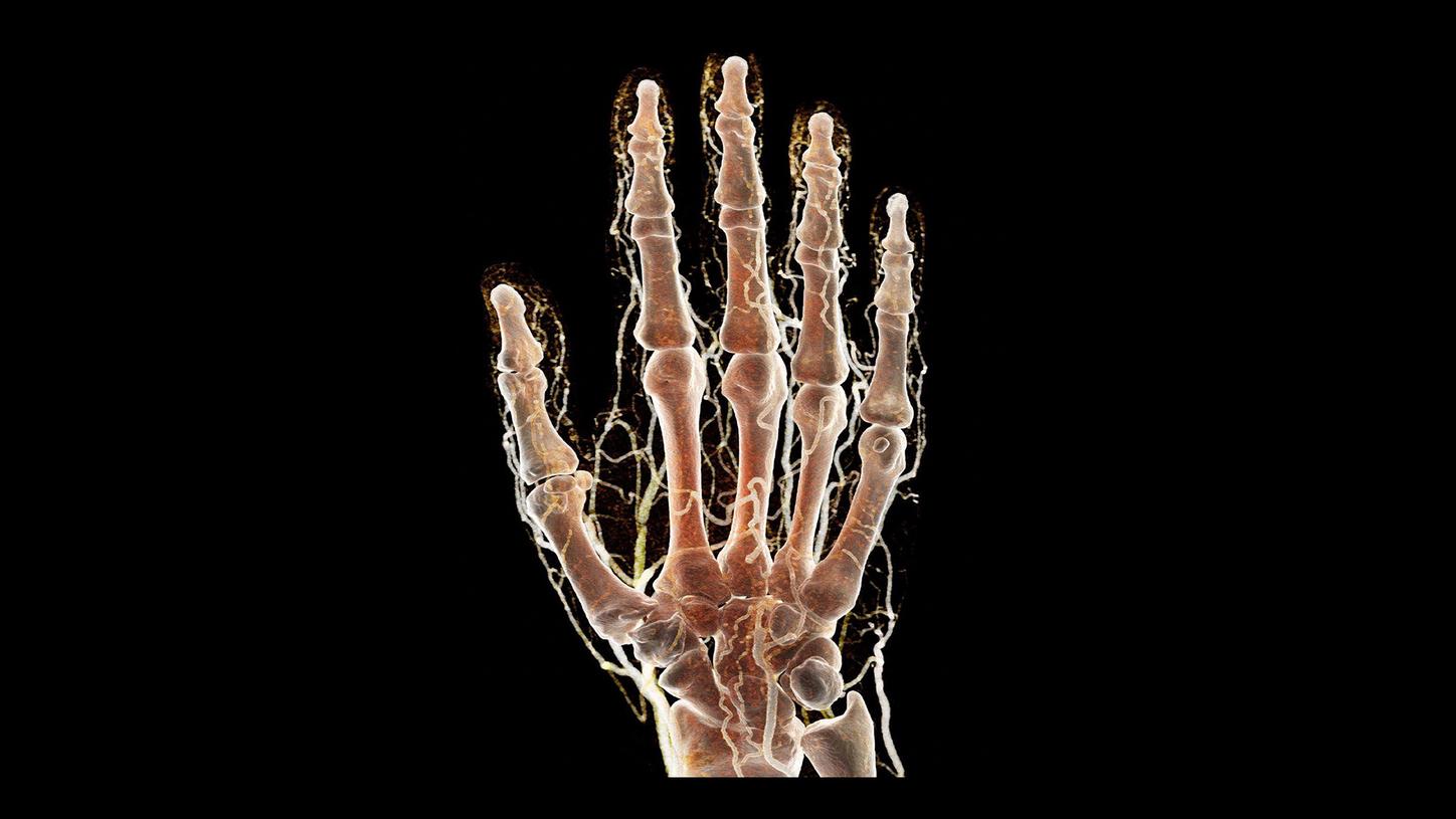 Quantum HD musculoskeletal image acquired by a NAEOTOM Alpha photon-counting CT scanner.