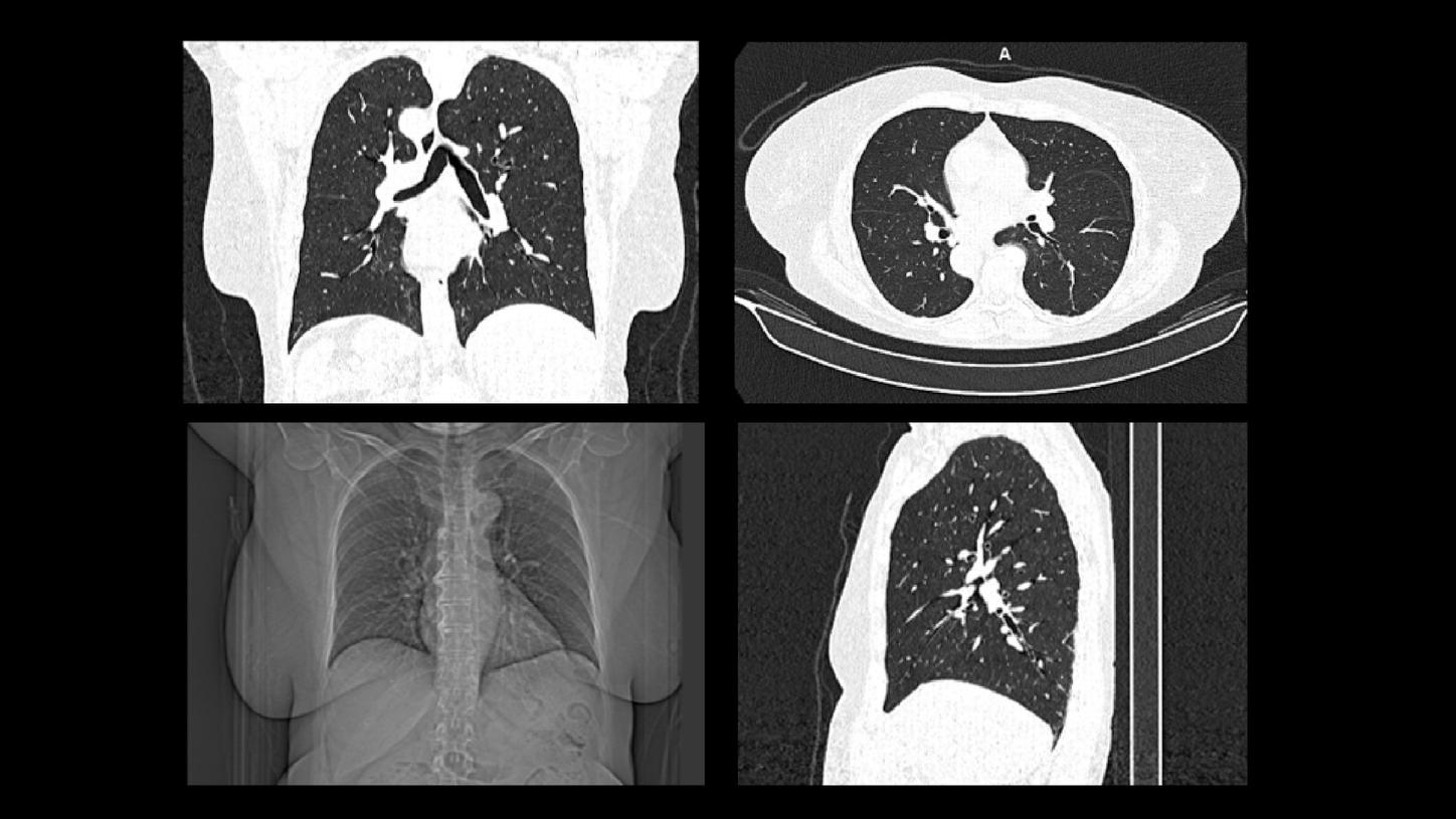 Low-dose CT scanners for lung cancer screening