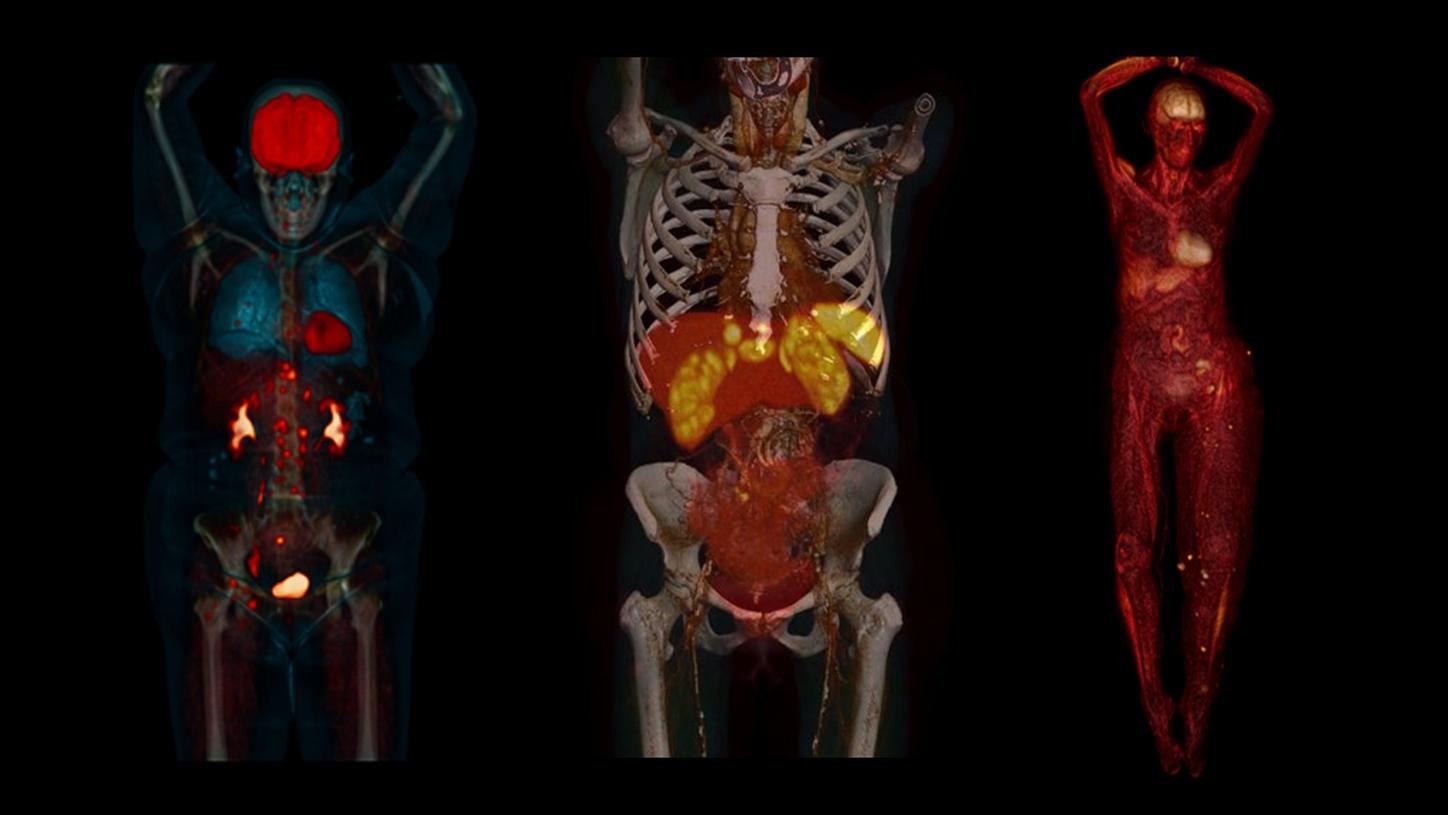 Total-body PET/CT: Finding answers today for tomorrow.