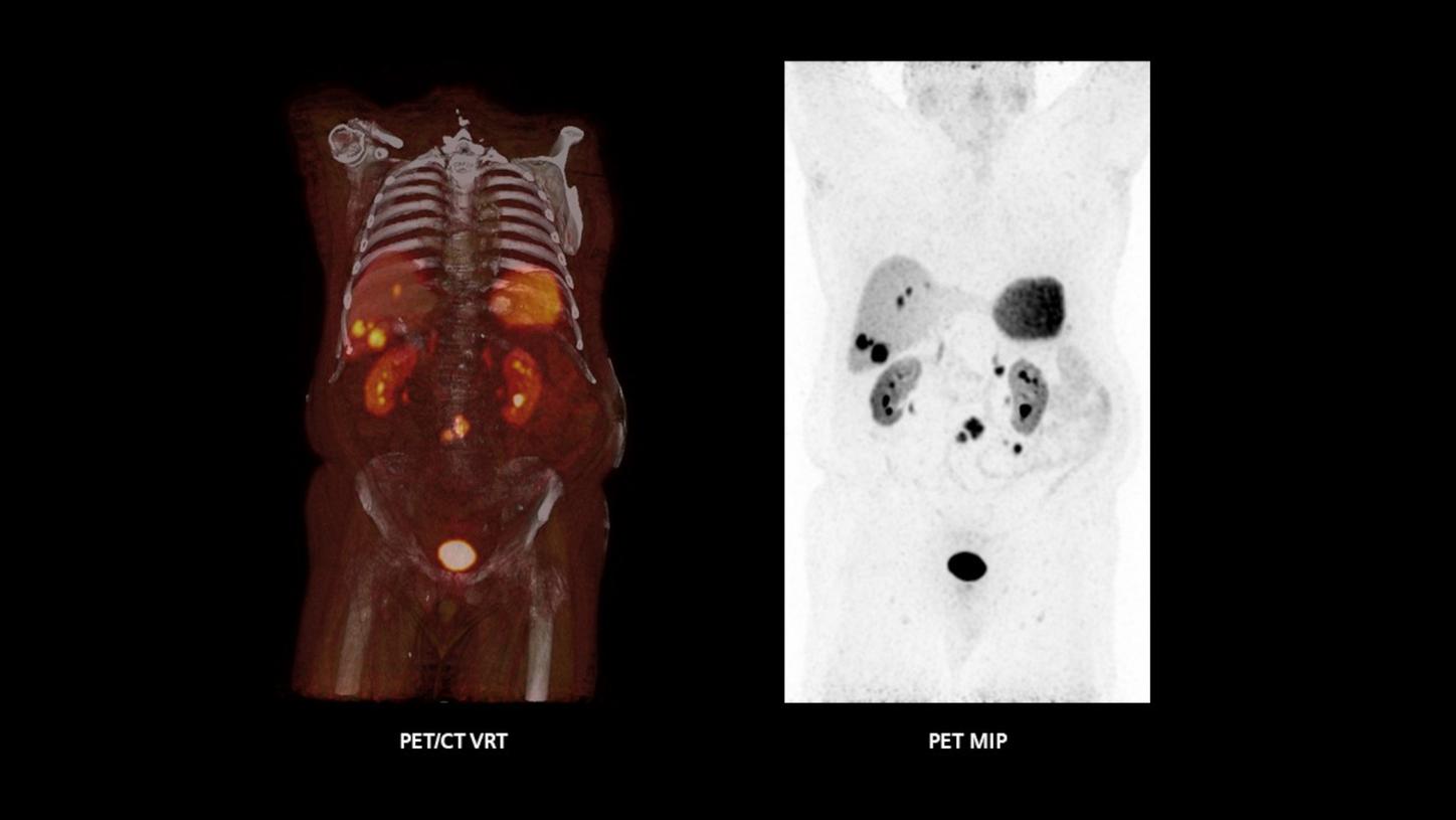 High-contrast 64Cu-DOTATATE PET/CT delineation of small liver and intestinal metastases