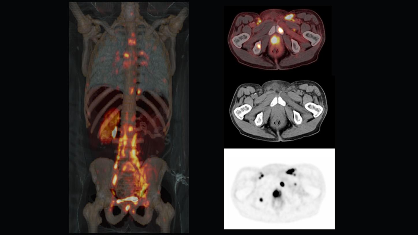 prostate molecular imaging clinical image