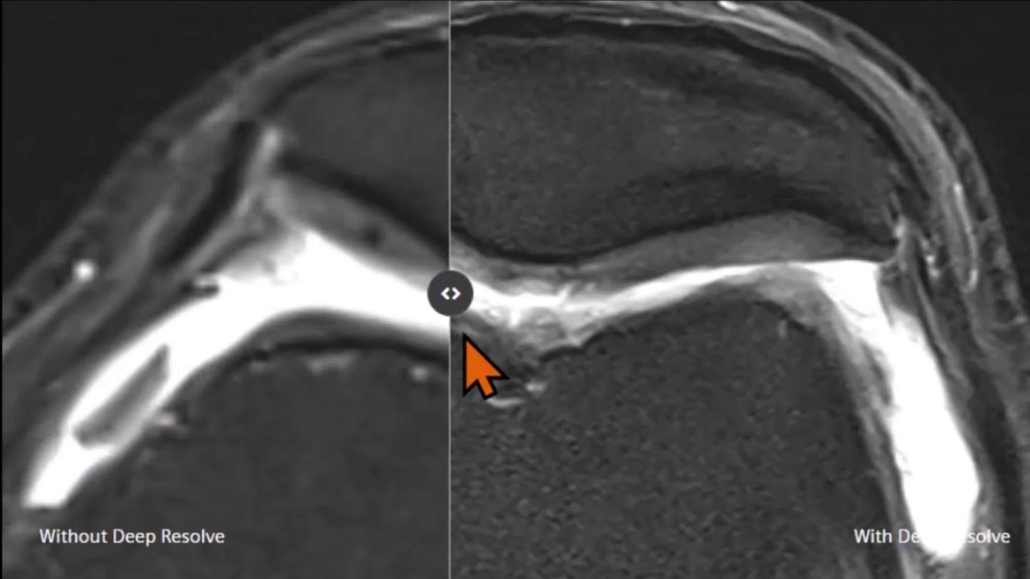 Siemens Healthineers MRI Energy Savings Deep Resolve Knee