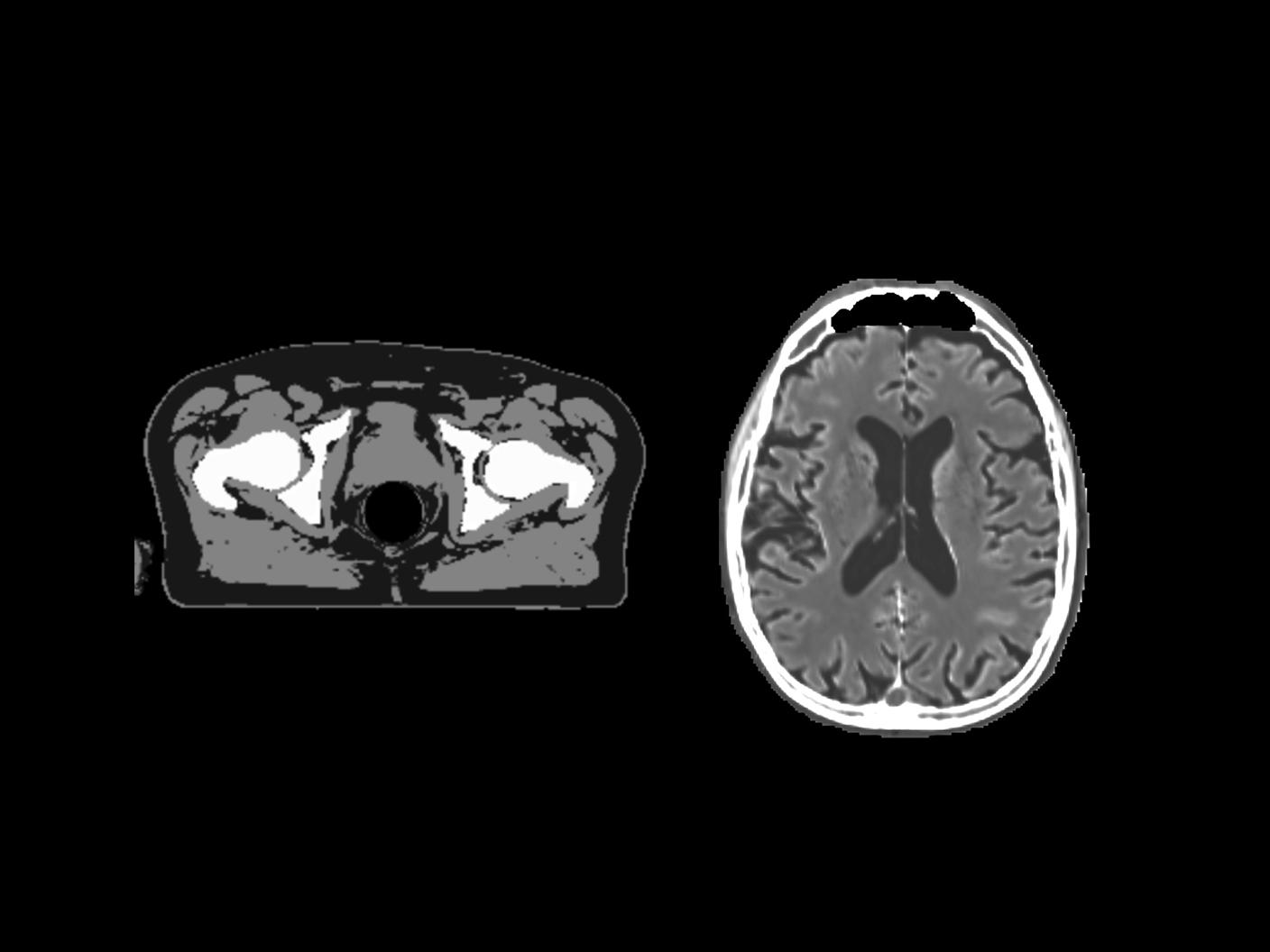 MR-only radiotherapy planning with Synthetic CT