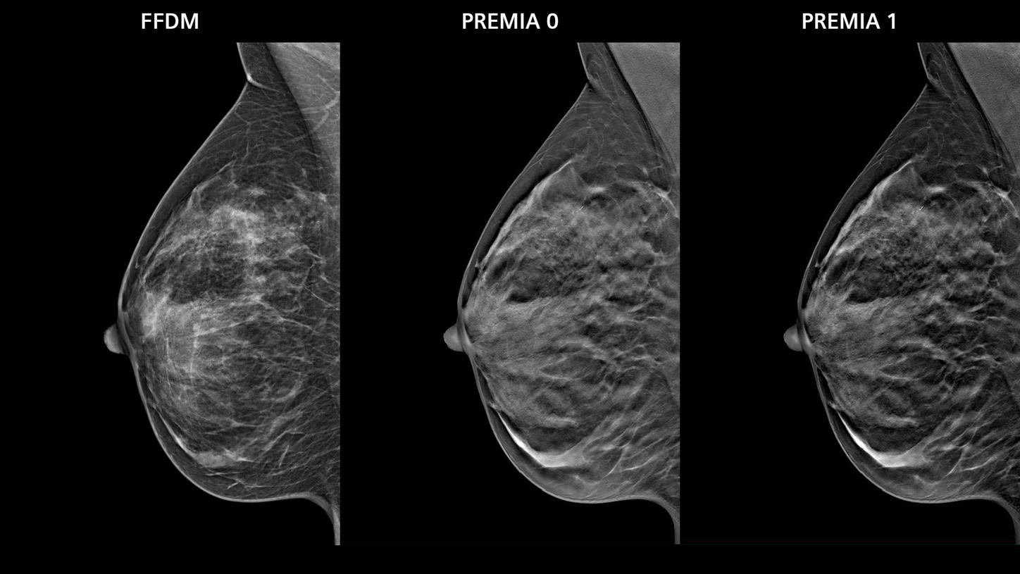 Three clinical breast images. Left: FFDM image, middle and right: PlatinumTomo images with PREMIA image flaver 0 and 1.