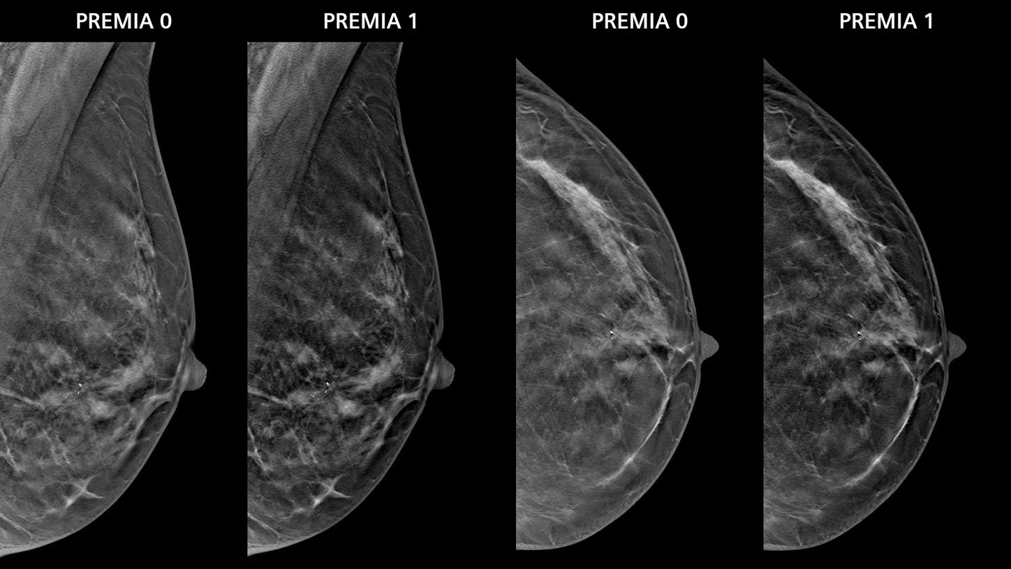 Two PlatinumTomo images of a breast, both shown with PREMIA image flaver 0 and 1.