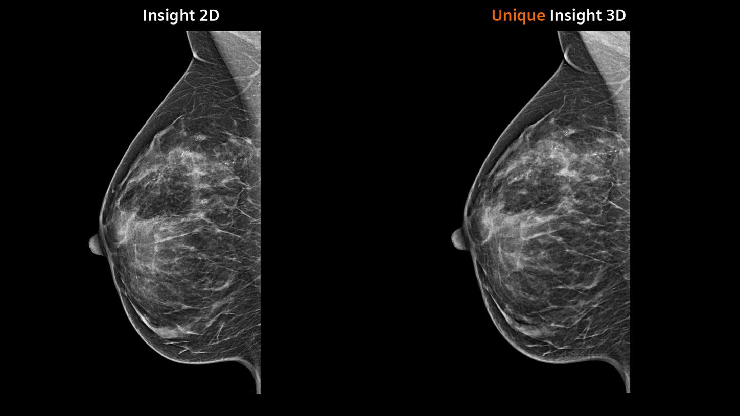 A synthetic mammogram made with Insight 2D next to mammogram made with Insight 3D