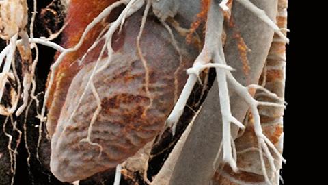 CT images are procced with an app using Cinematic Rendering