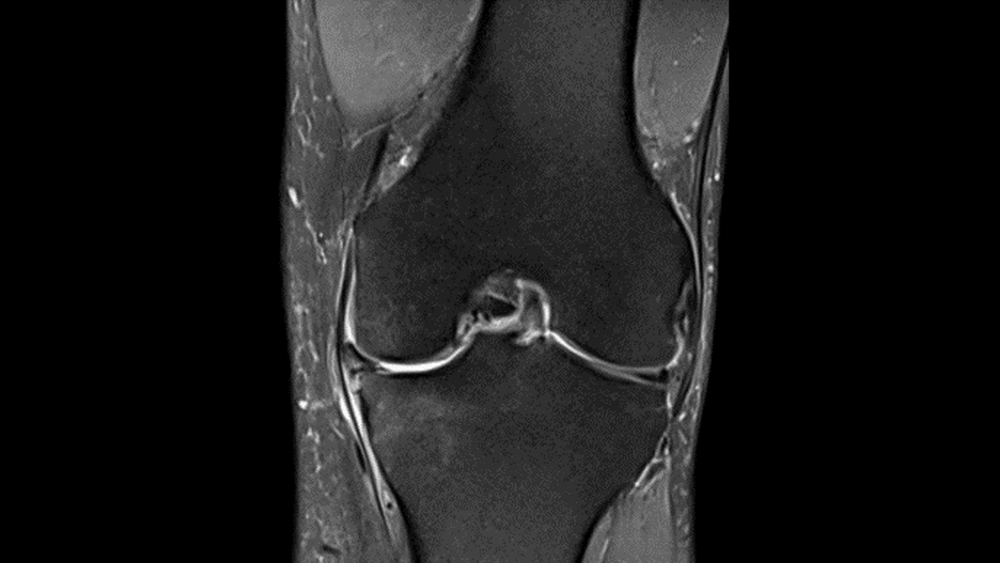 Key investigation areas for MRI are soft tissue areas like brain, abdomen, vessels, ligaments, cartilages or muscles.