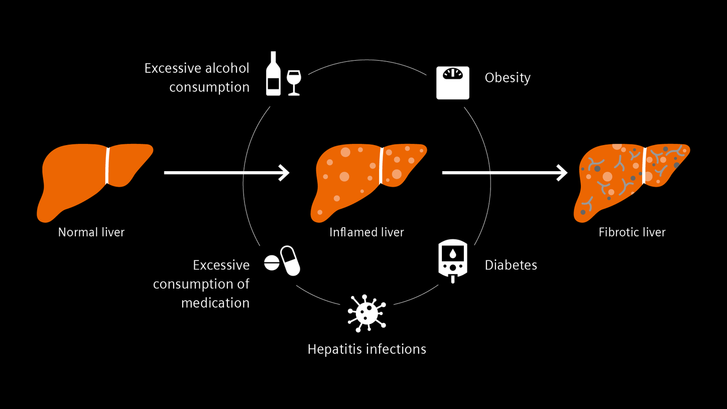 Infographic on liver disease causes
