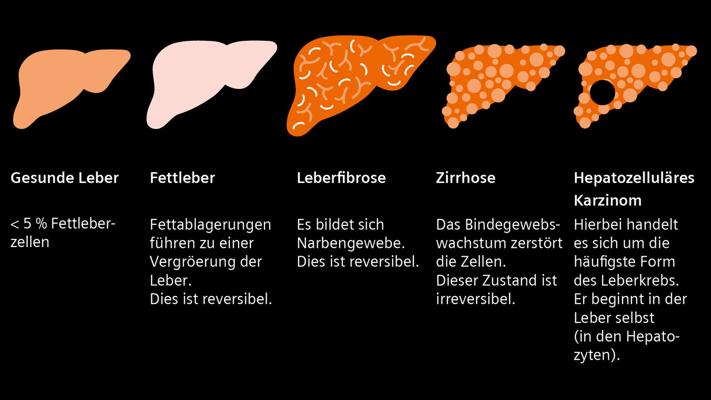 Infografik zum Fortschreiten der Lebererkrankung in 5 Stadien