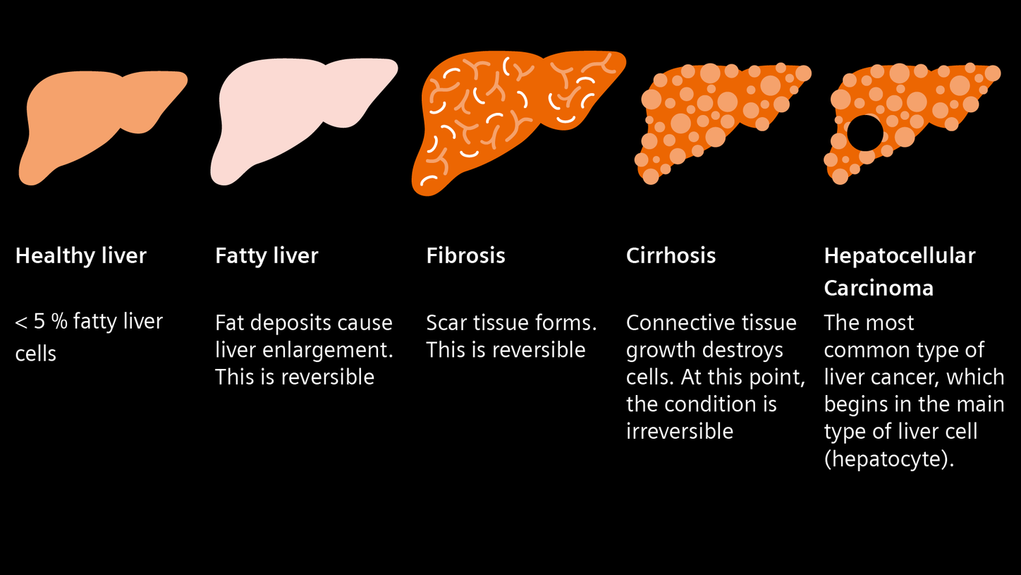 Infographic of liver disease progression shown in 5 stages