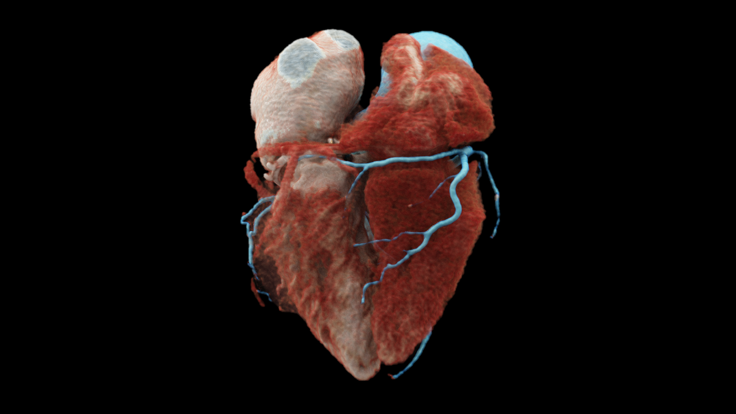 NAEOTOM Alpha allows spectral imaging for cardiac scans